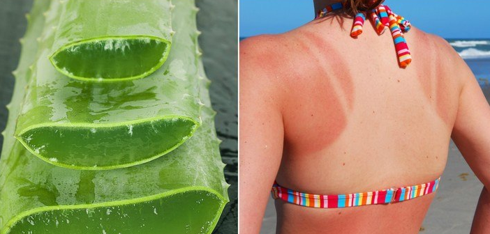 Featured image of post Güneş yanığı İçin Aloe Vera'yı Kullanmanın 3 Yolu