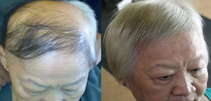 Saç Dökülmesi İçin Evde Serum Hazırlayın