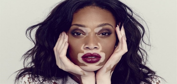 Featured image of post Vitiligo (Ala Hastalığı) İçin Doğal Tedavi Yöntemleri