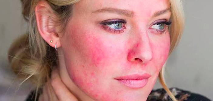Rosacea için Doğal Tedaviler ve Ev İlaçları