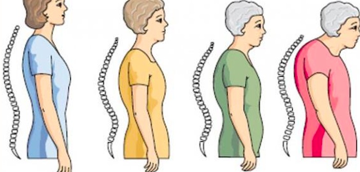 Featured image of post Muhtemelen Görmezden Geldiğiniz Osteoporozun 7 Belirtisi
