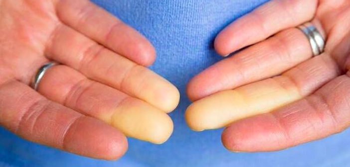 Raynaud Hastalığı Doğal Olarak Nasıl Tedavi Edilir?