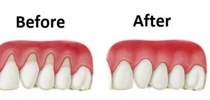 Featured image of post Diş Eti Çekilmesine Doğal Çözümler