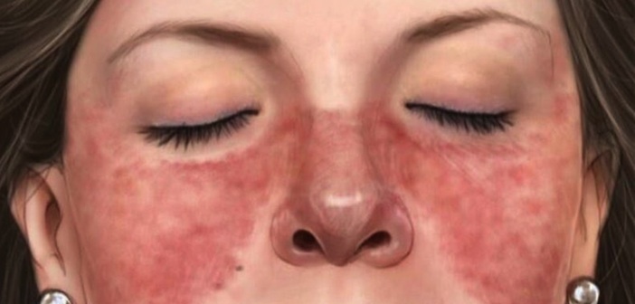 Kadınlarda Kelebek Hastalığının (Lupus) Belirtileri